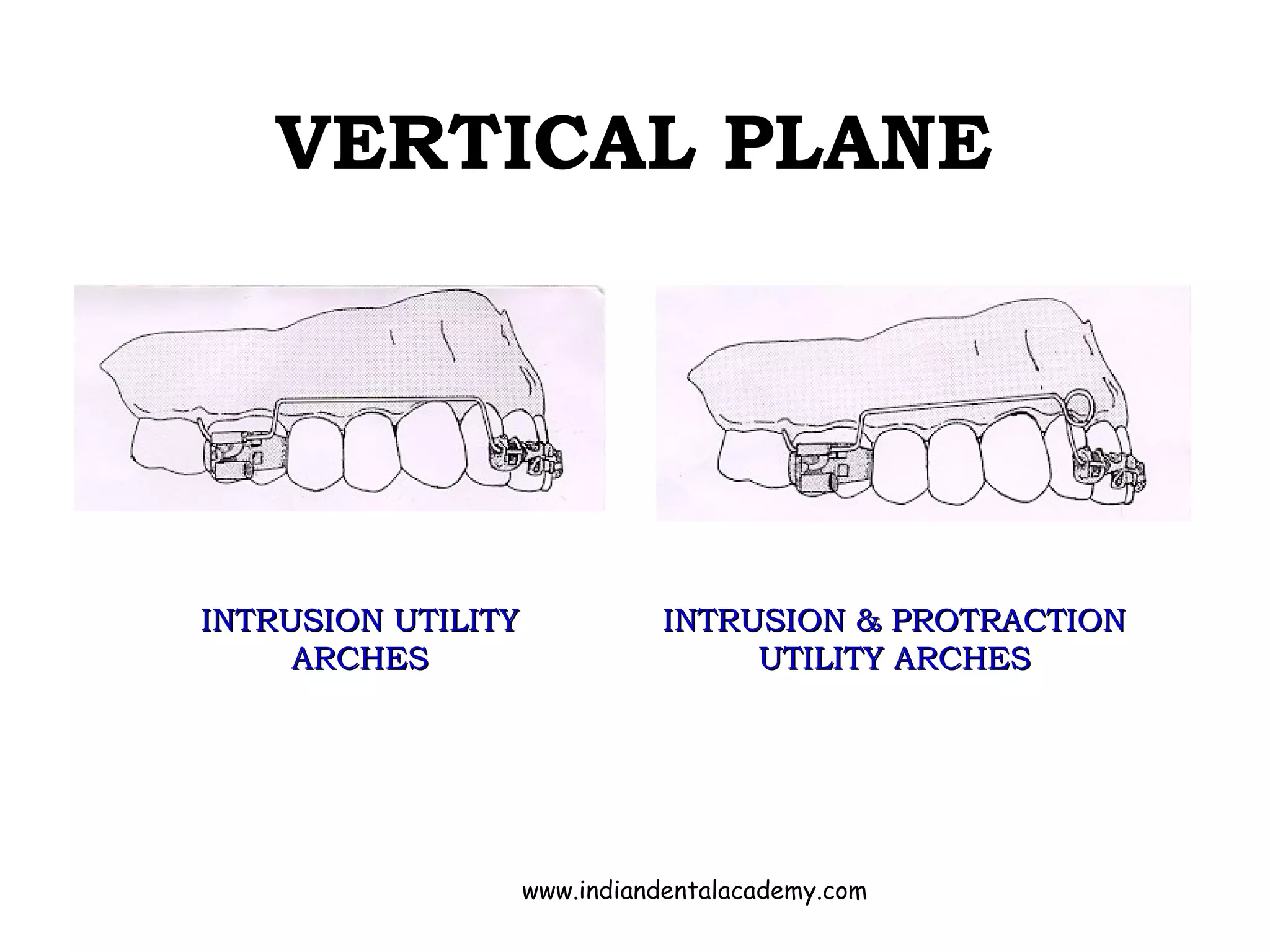 VERTICAL PLANE
INTRUSION UTILITYINTRUSION UTILITY
ARCHESARCHES
INTRUSION & PROTRACTIONINTRUSION & PROTRACTION
UTILITY ARCHESUTILITY ARCHES
www.indiandentalacademy.com
 