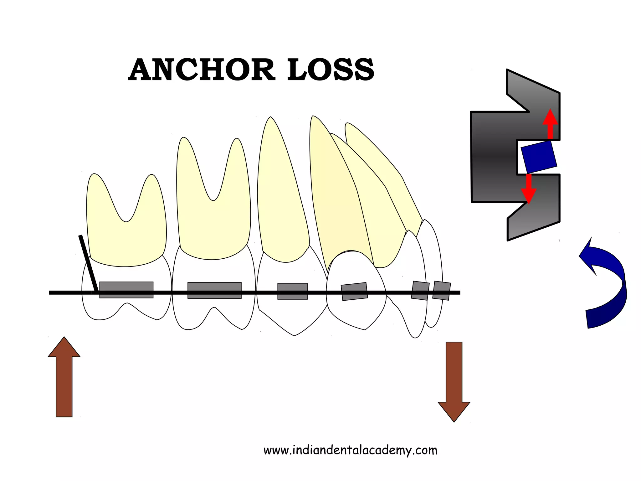 ANCHOR LOSS
www.indiandentalacademy.com
 