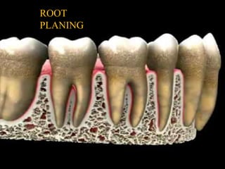 ROOT
PLANING
 