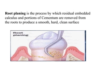 Root planing is the process by which residual embedded
calculus and portions of Cementum are removed from
the roots to produce a smooth, hard, clean surface
 