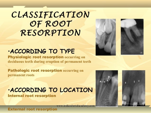 root resorption