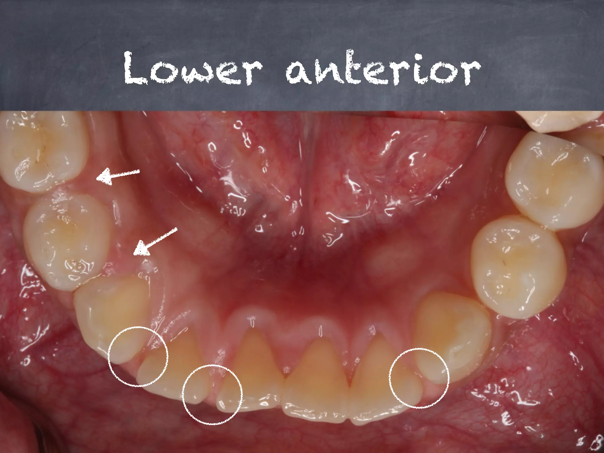 Lower anterior 
 
