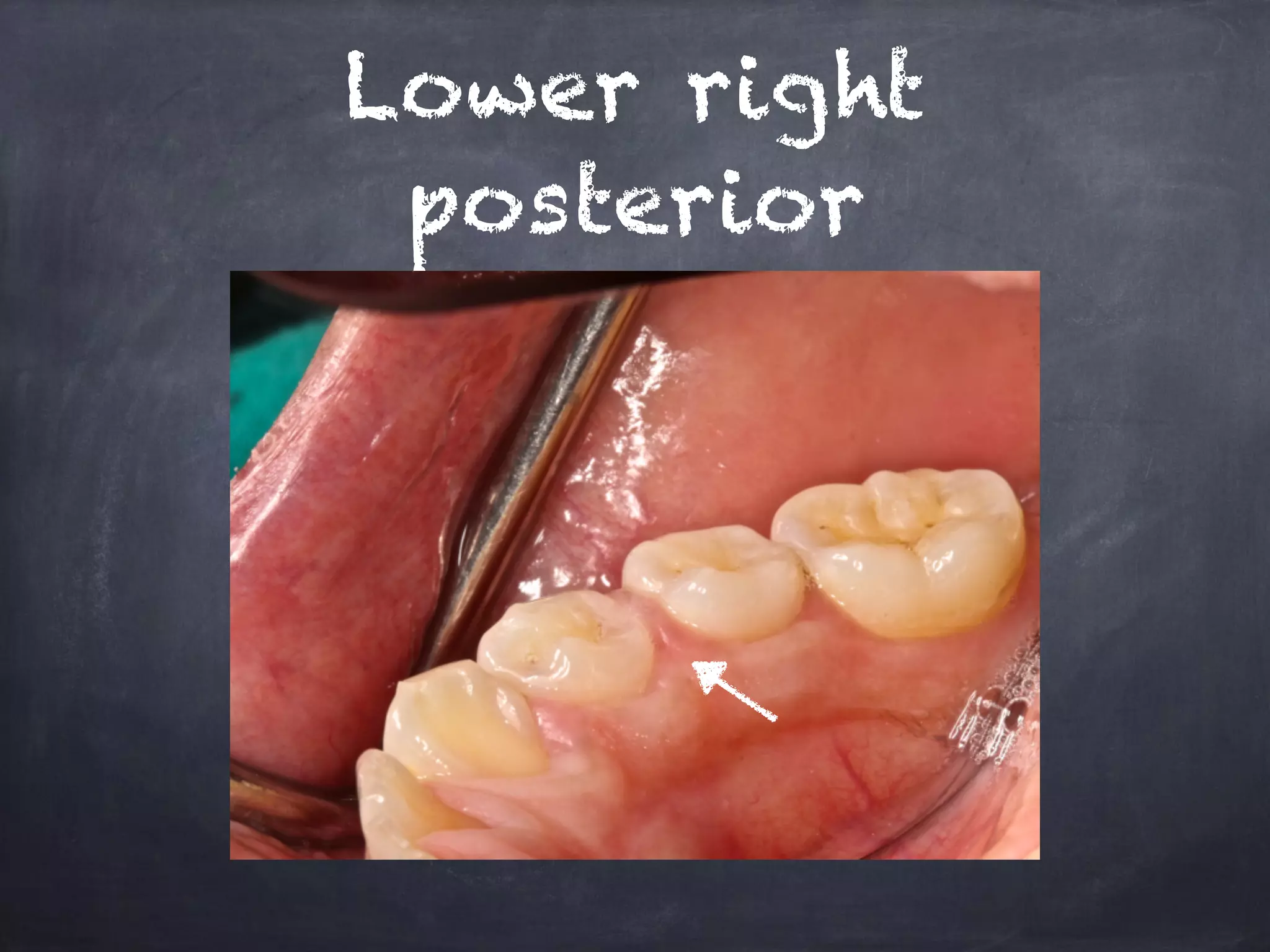 Lower right 
posterior 
 