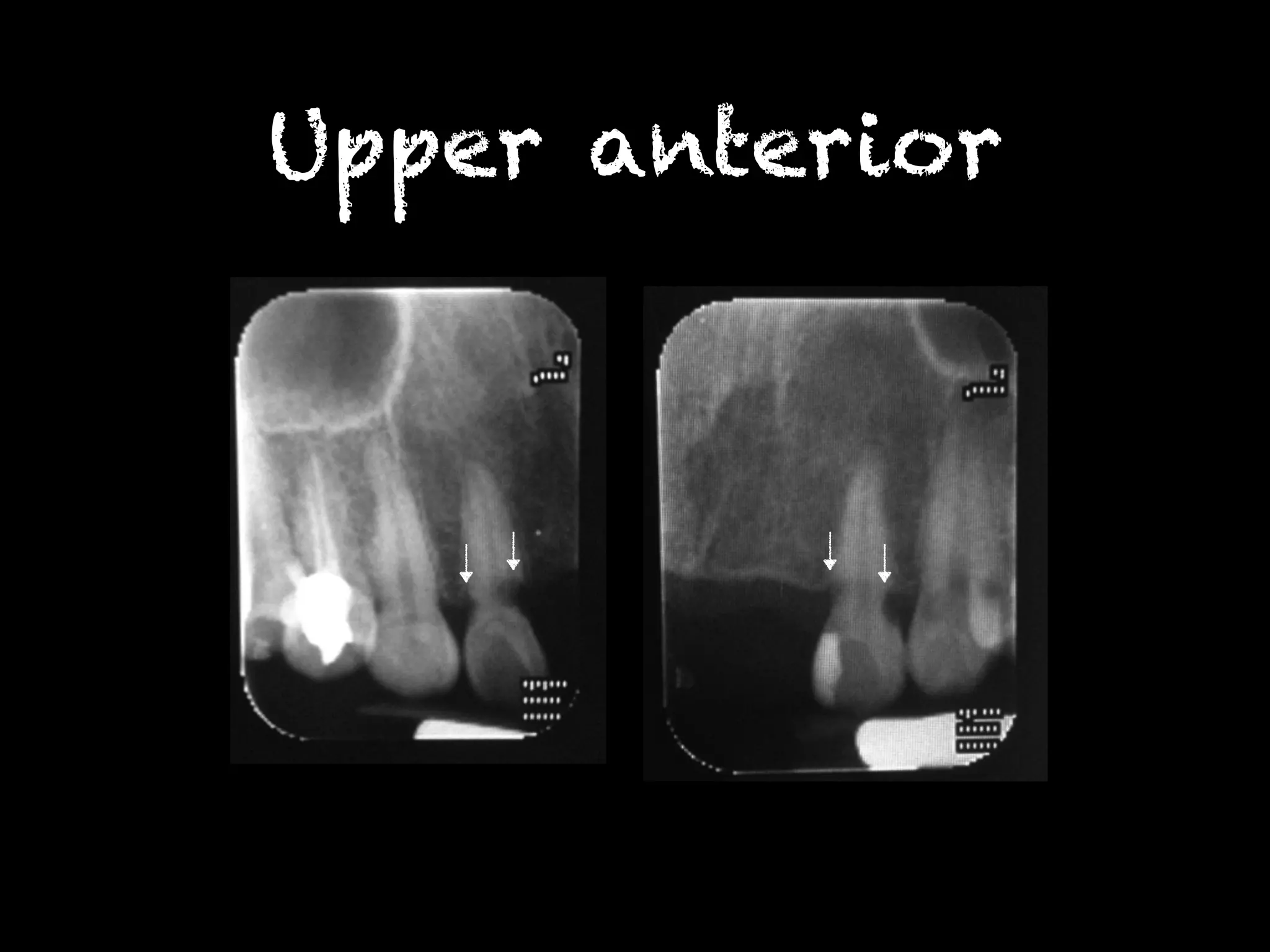 Upper anterior 
 