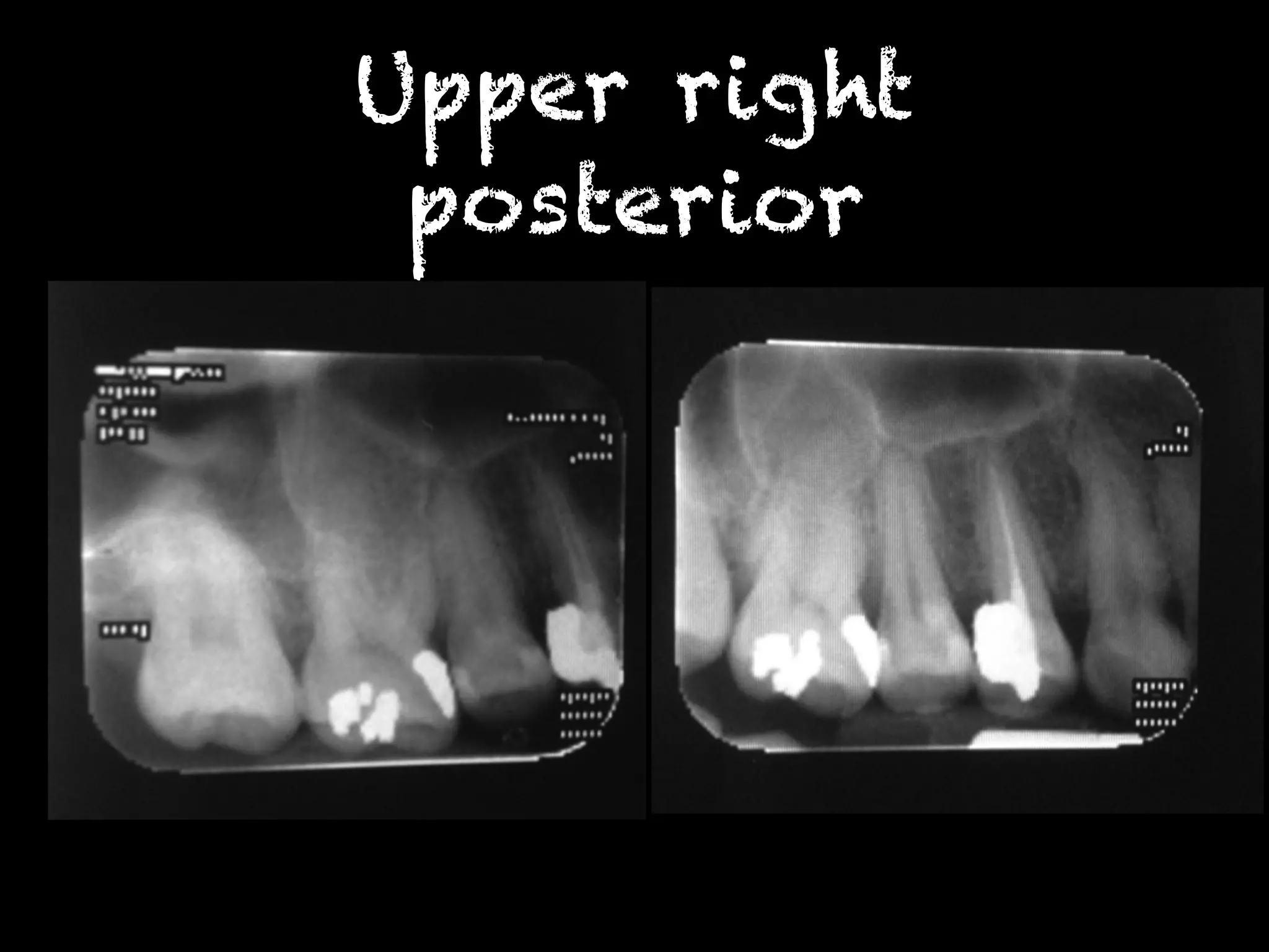 Upper right 
posterior 
 