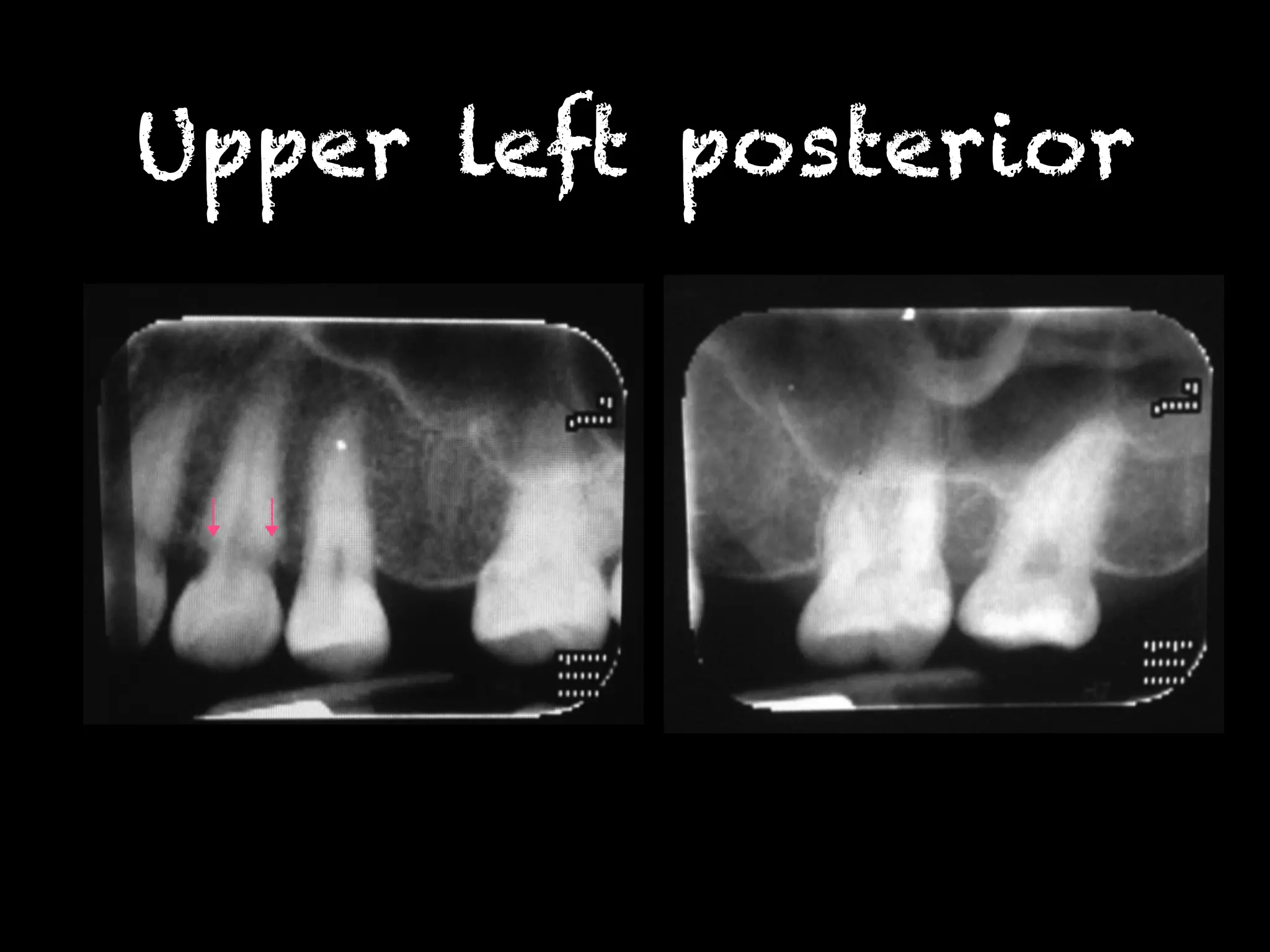 Upper left posterior 
 