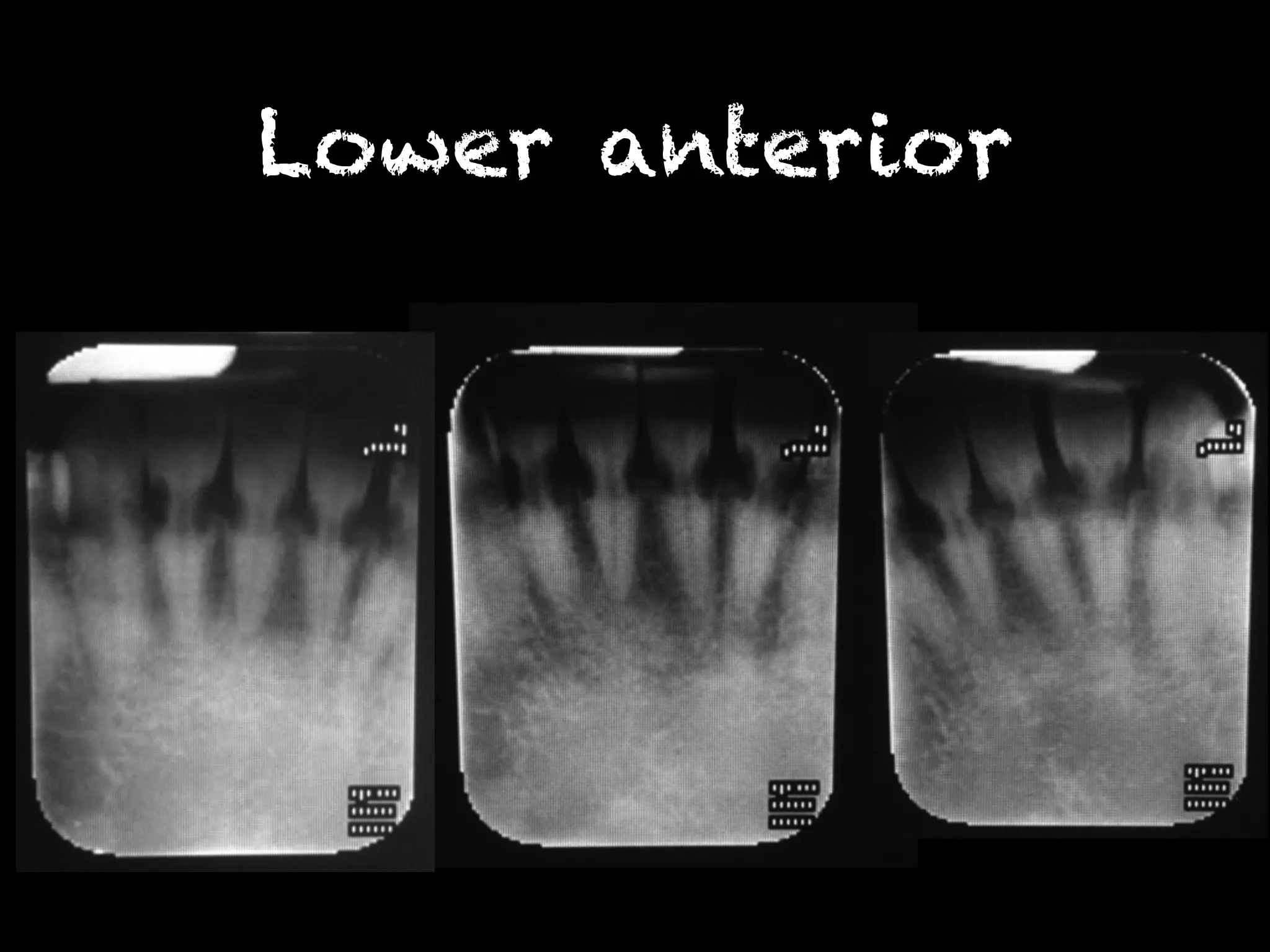 Lower anterior 
 