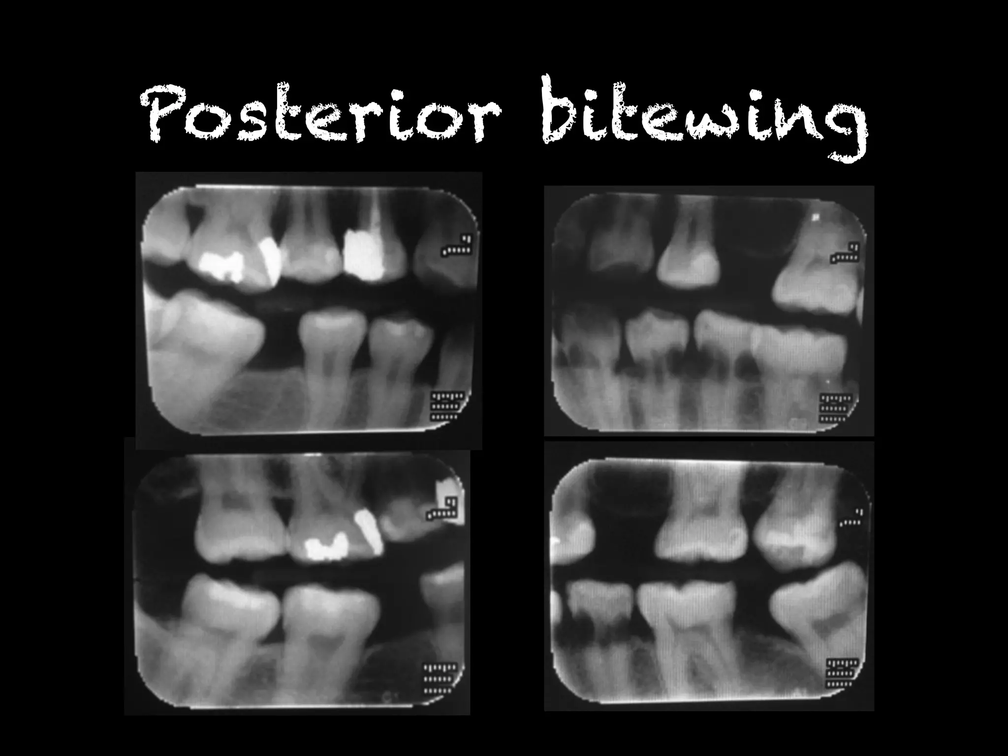 Posterior bitewing 
 