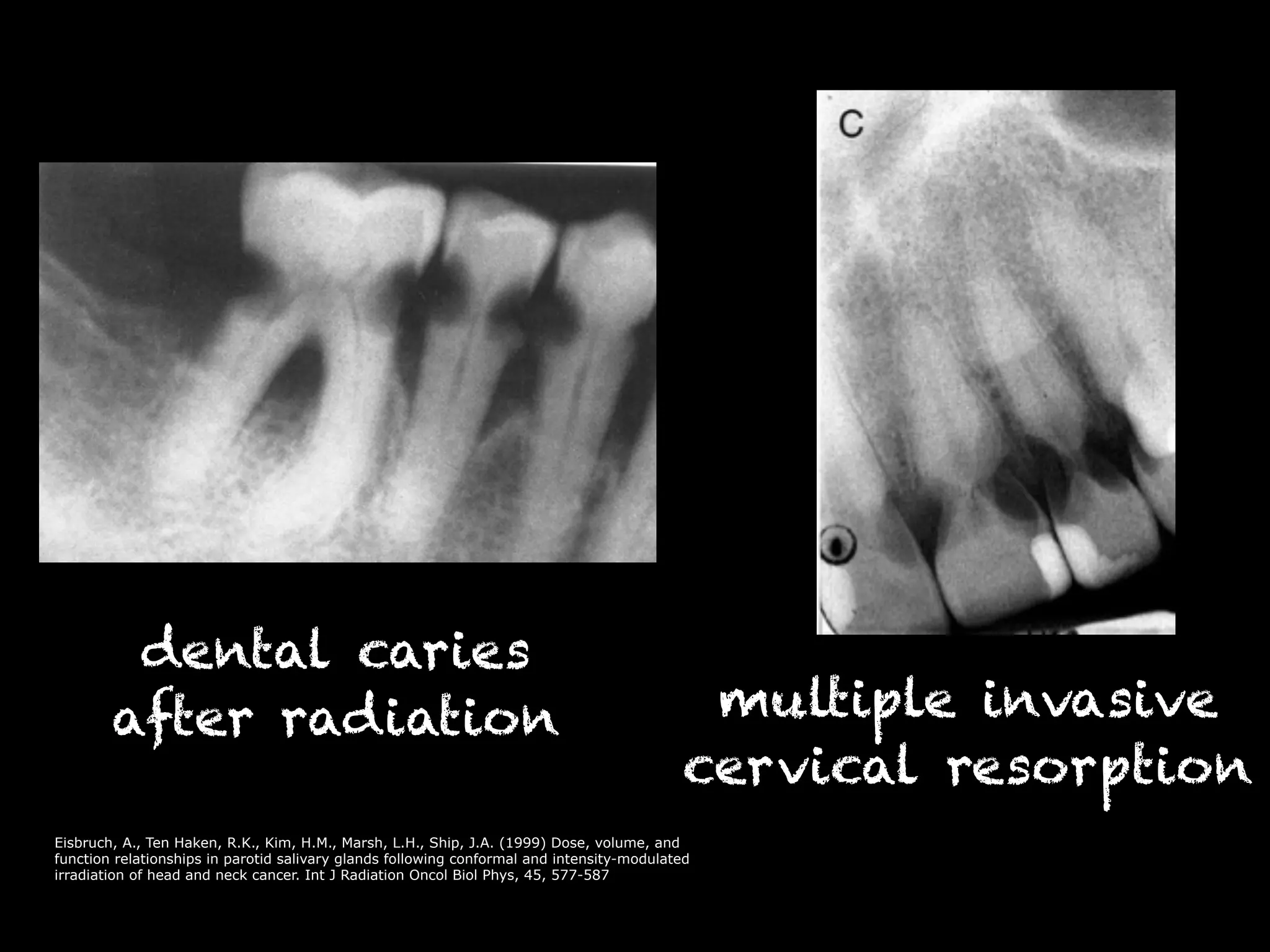 dental caries 
after radiation multiple invasive 
cervical resorption 
Eisbruch, A., Ten Haken, R.K., Kim, H.M., Marsh, L.H., Ship, J.A. (1999) Dose, volume, and 
function relationships in parotid salivary glands following conformal and intensity-modulated 
irradiation of head and neck cancer. Int J Radiation Oncol Biol Phys, 45, 577-587 
 