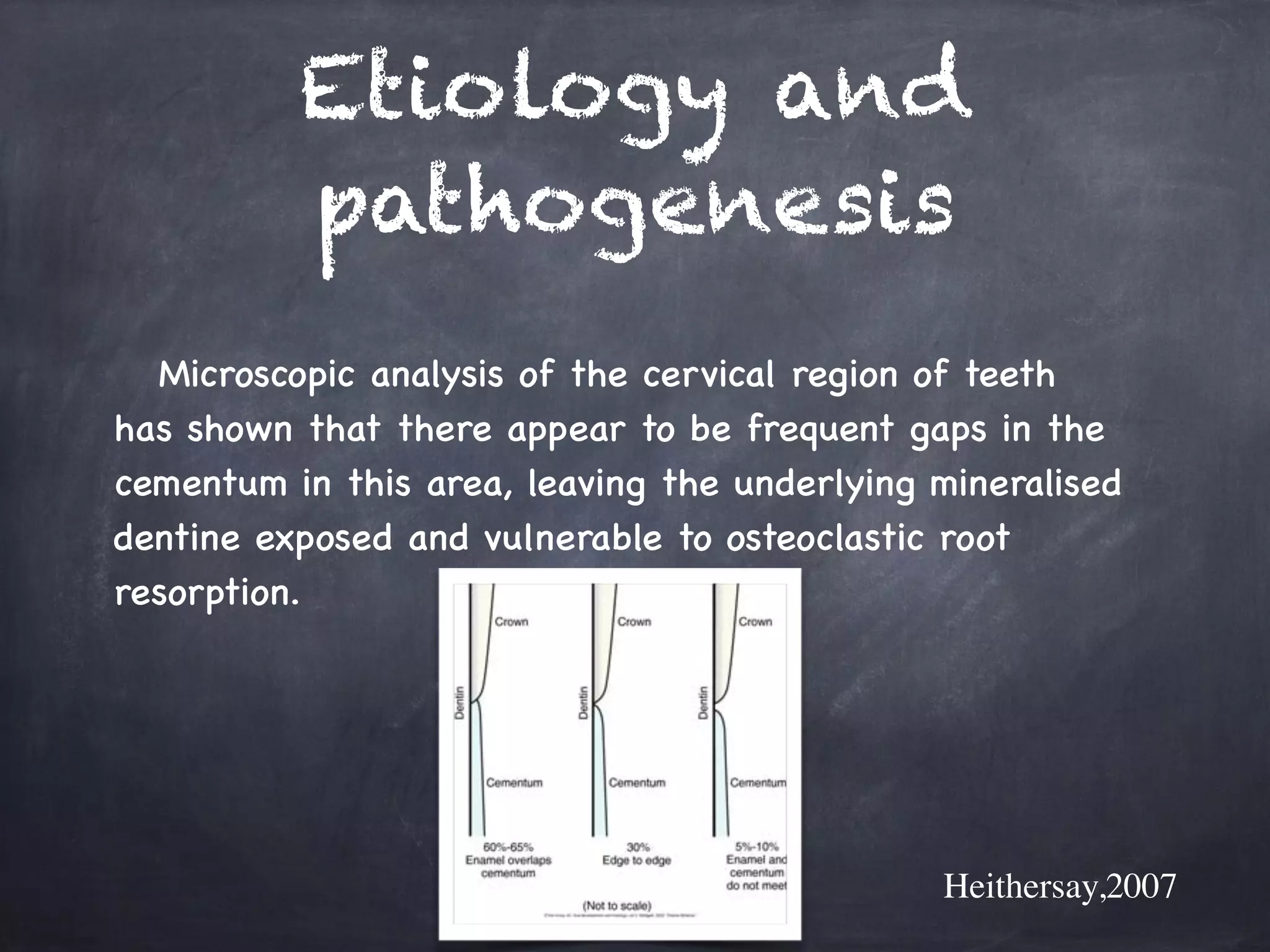 Etiology and 
pathogenesis 
Microscopic analysis of the cervical region of teeth 
has shown that there appear to be frequent gaps in the 
cementum in this area, leaving the underlying mineralised 
dentine exposed and vulnerable to osteoclastic root 
resorption. 
Heithersay,2007 
 