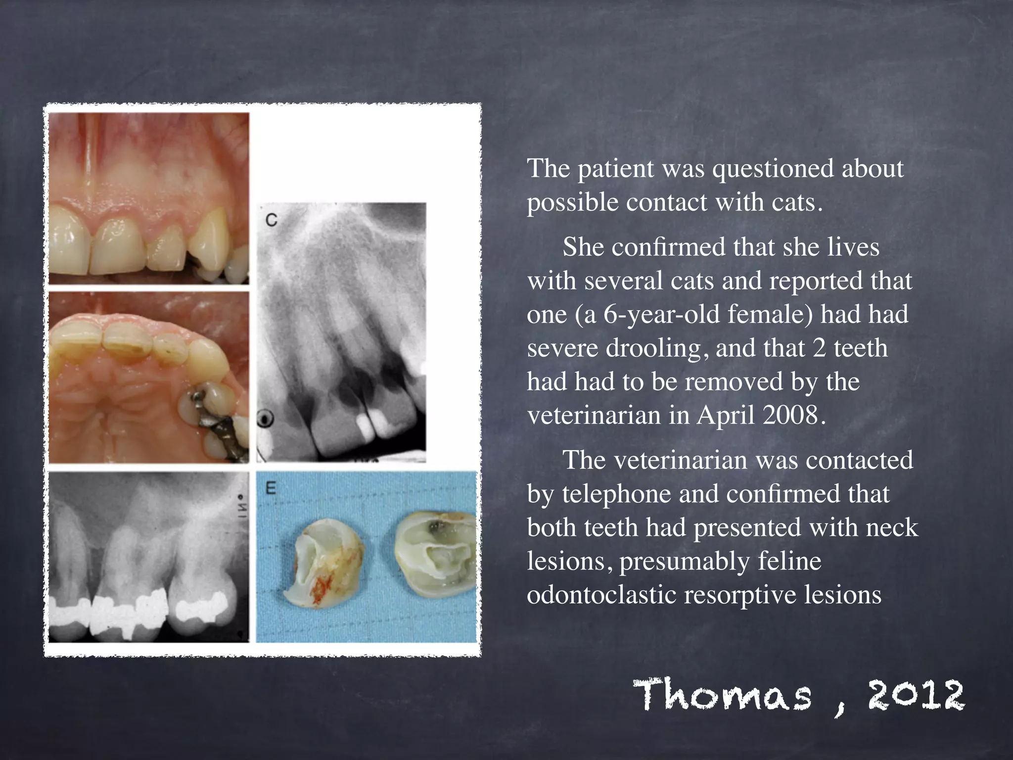 The patient was questioned about 
possible contact with cats. 
She confirmed that she lives 
with several cats and reported that 
one (a 6-year-old female) had had 
severe drooling, and that 2 teeth 
had had to be removed by the 
veterinarian in April 2008. 
The veterinarian was contacted 
by telephone and confirmed that 
both teeth had presented with neck 
lesions, presumably feline 
odontoclastic resorptive lesions 
Thomas , 2012 
 