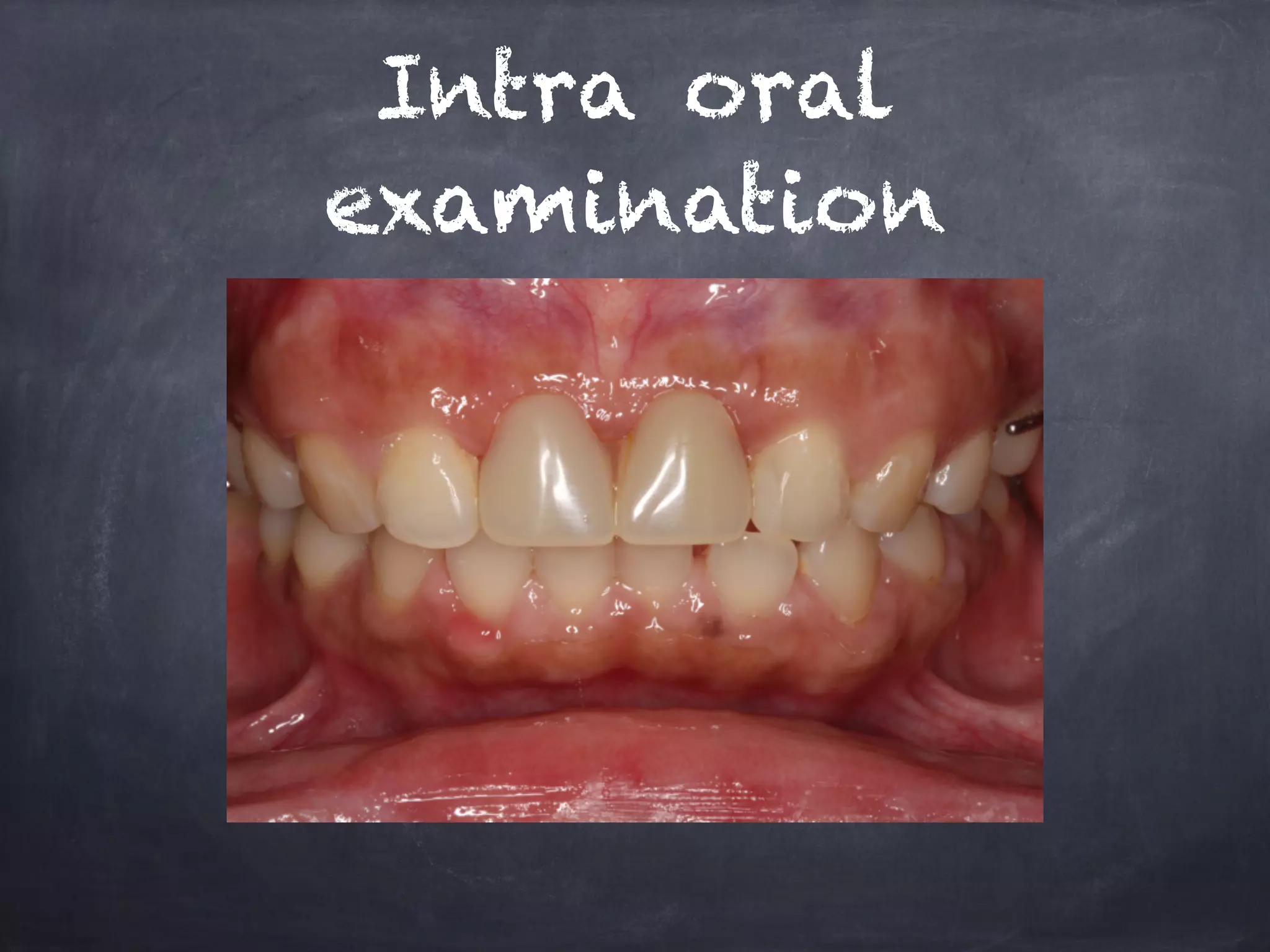 Intra oral 
examination 
 