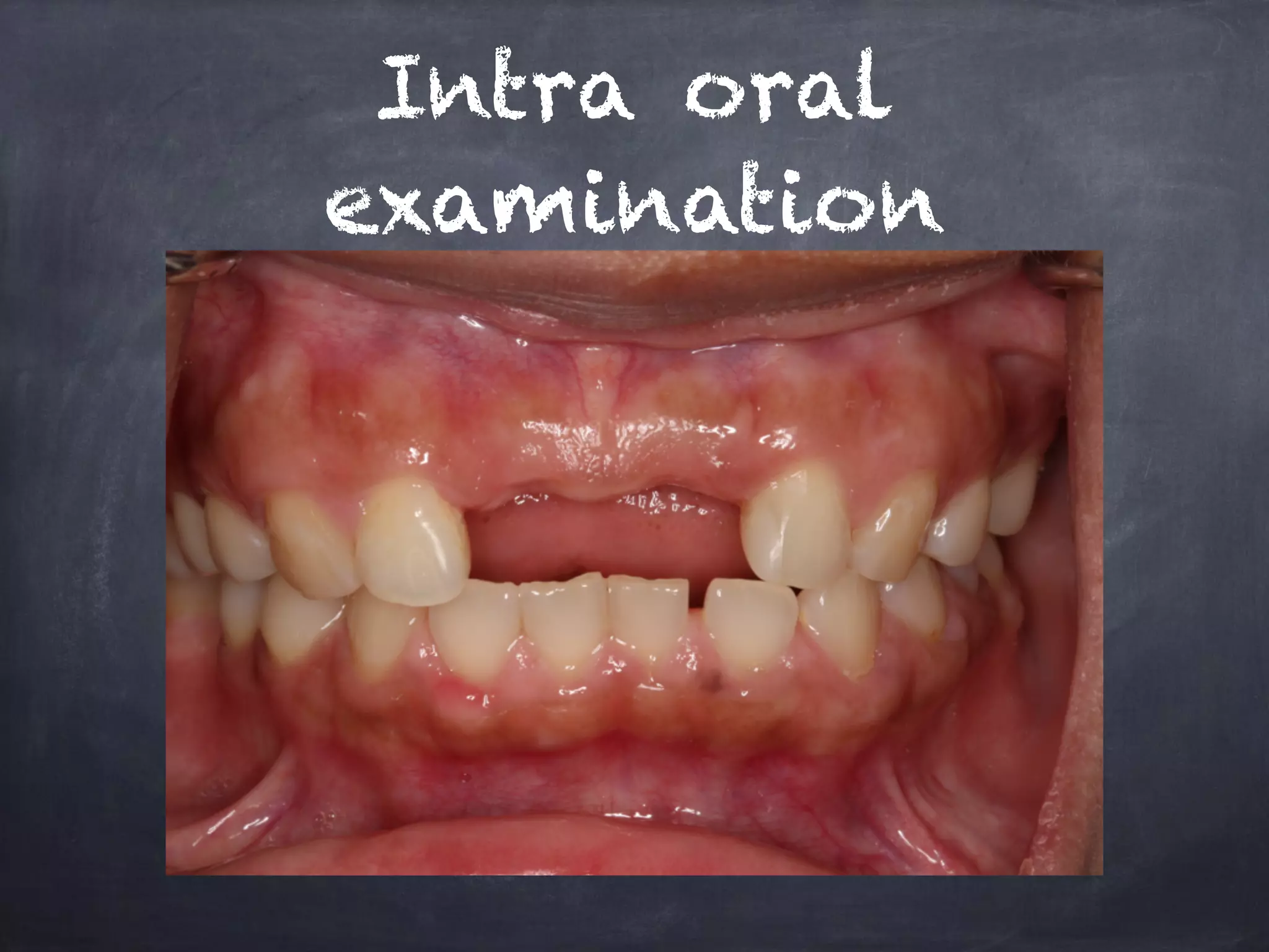 Intra oral 
examination 
 