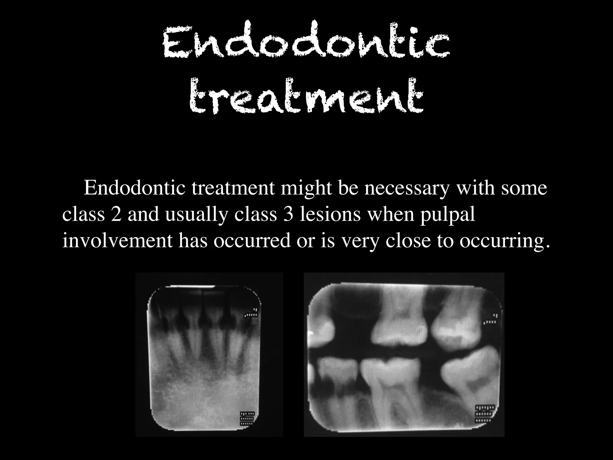Endodontic 
treatment 
Endodontic treatment might be necessary with some 
class 2 and usually class 3 lesions when pulpal 
involvement has occurred or is very close to occurring. 
 