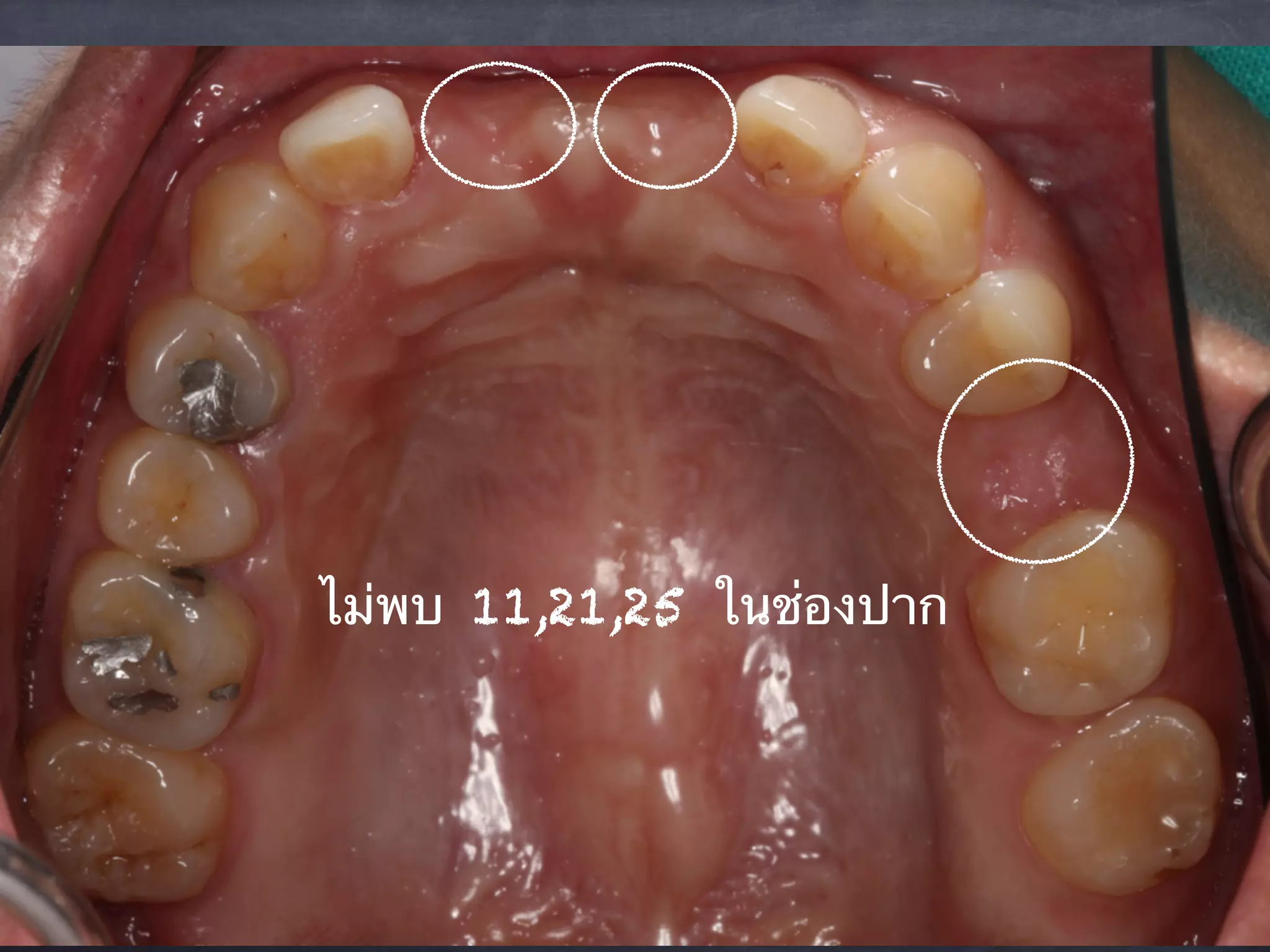 ไม่พบ 11,21,25 ในช่องปาก 
 
