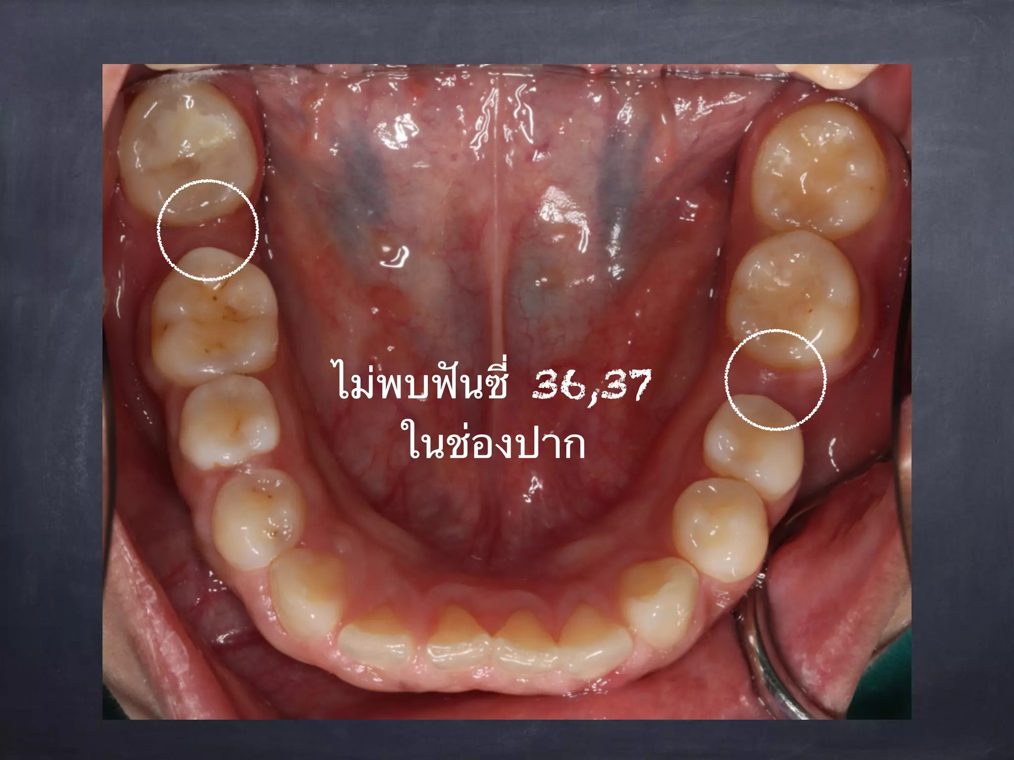 ไม่พบฟันซี่ 36,37 
ในช่องปาก 
 