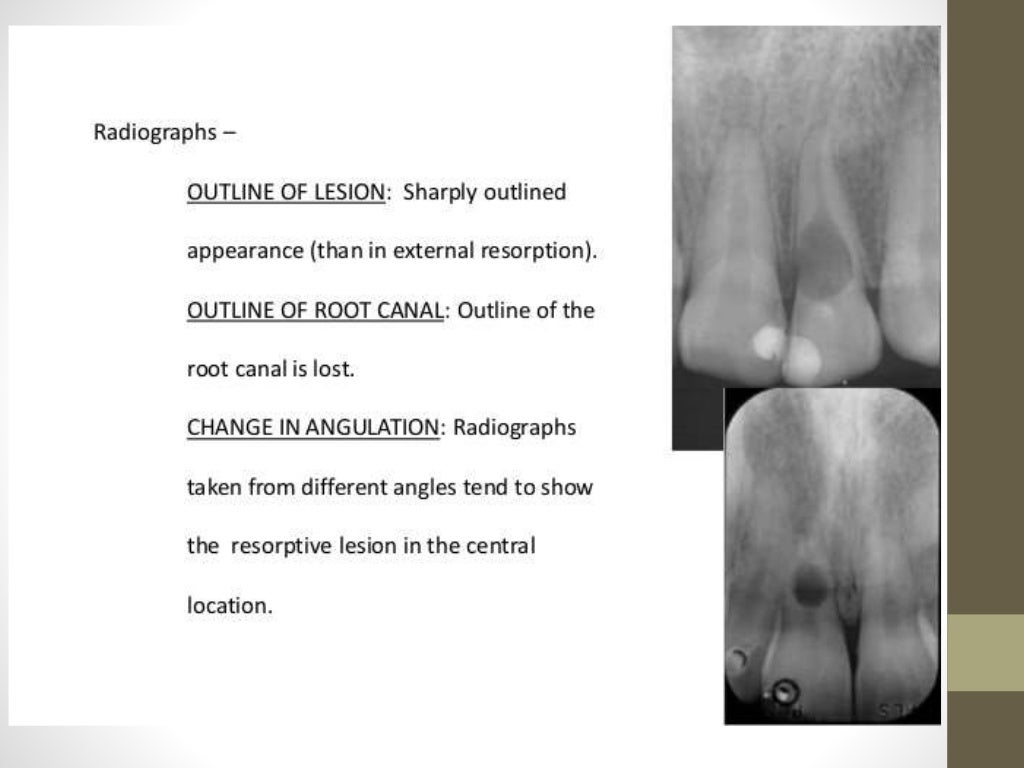 Root Resorption root-resorption