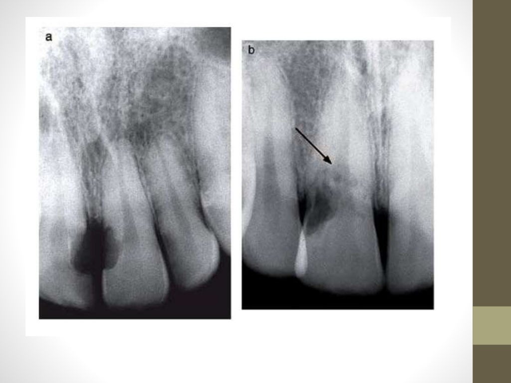Root Resorption