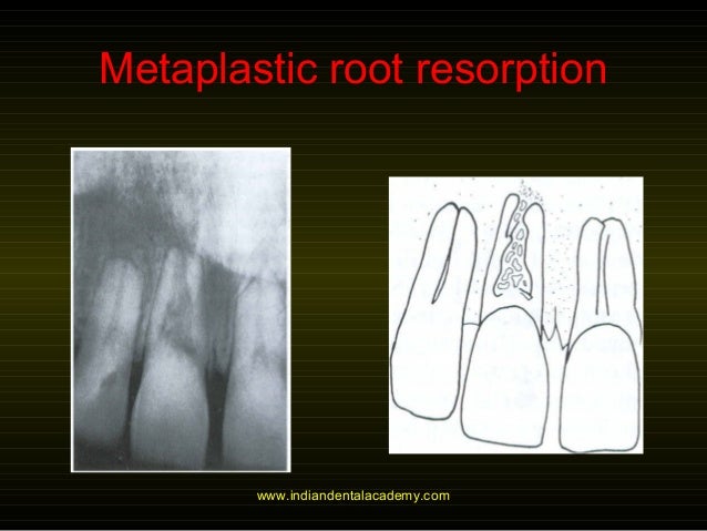 root resorption