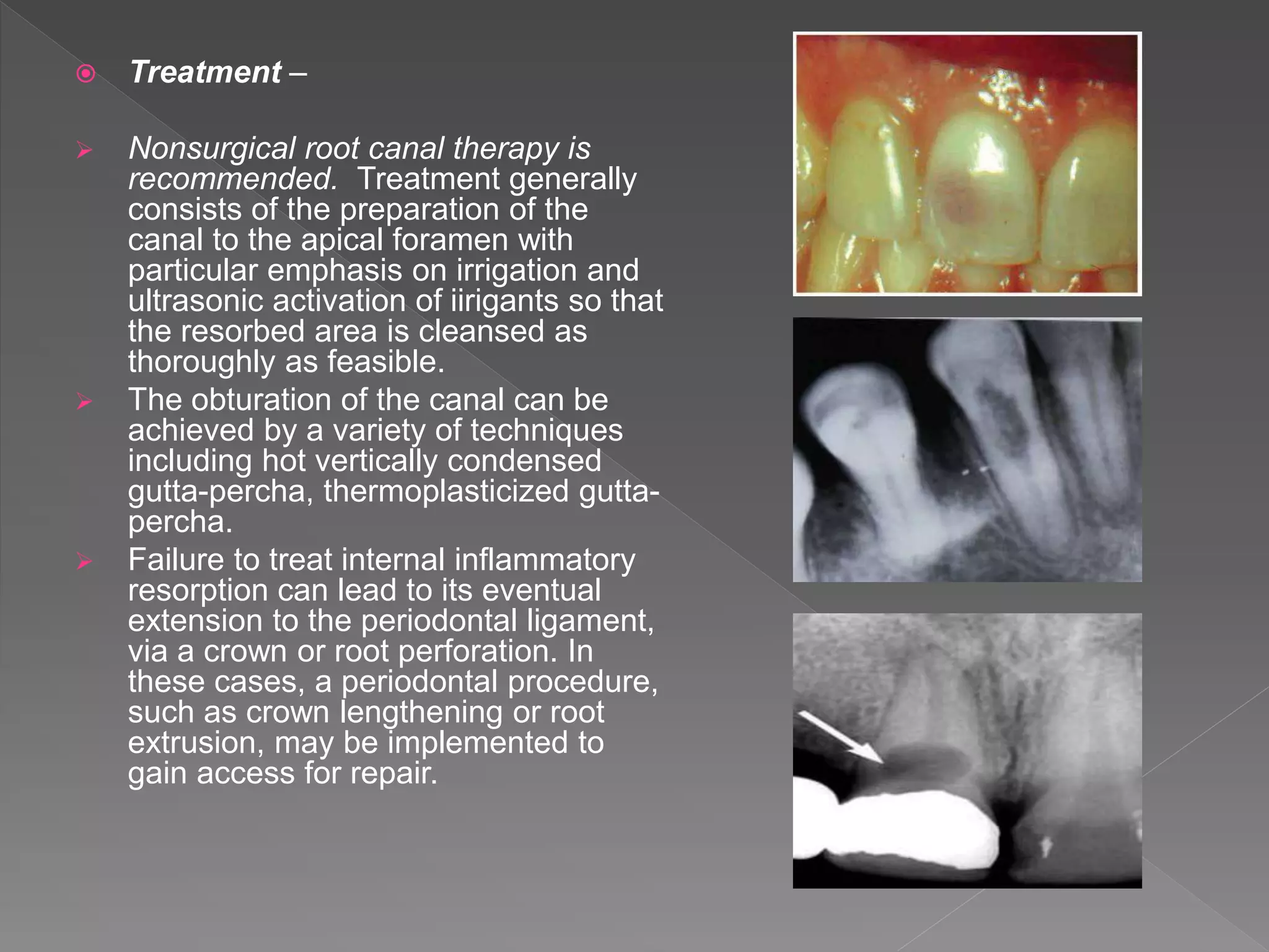  Treatment –
 Nonsurgical root canal therapy is
recommended. Treatment generally
consists of the preparation of the
canal to the apical foramen with
particular emphasis on irrigation and
ultrasonic activation of iirigants so that
the resorbed area is cleansed as
thoroughly as feasible.
 The obturation of the canal can be
achieved by a variety of techniques
including hot vertically condensed
gutta-percha, thermoplasticized gutta-
percha.
 Failure to treat internal inflammatory
resorption can lead to its eventual
extension to the periodontal ligament,
via a crown or root perforation. In
these cases, a periodontal procedure,
such as crown lengthening or root
extrusion, may be implemented to
gain access for repair.
 