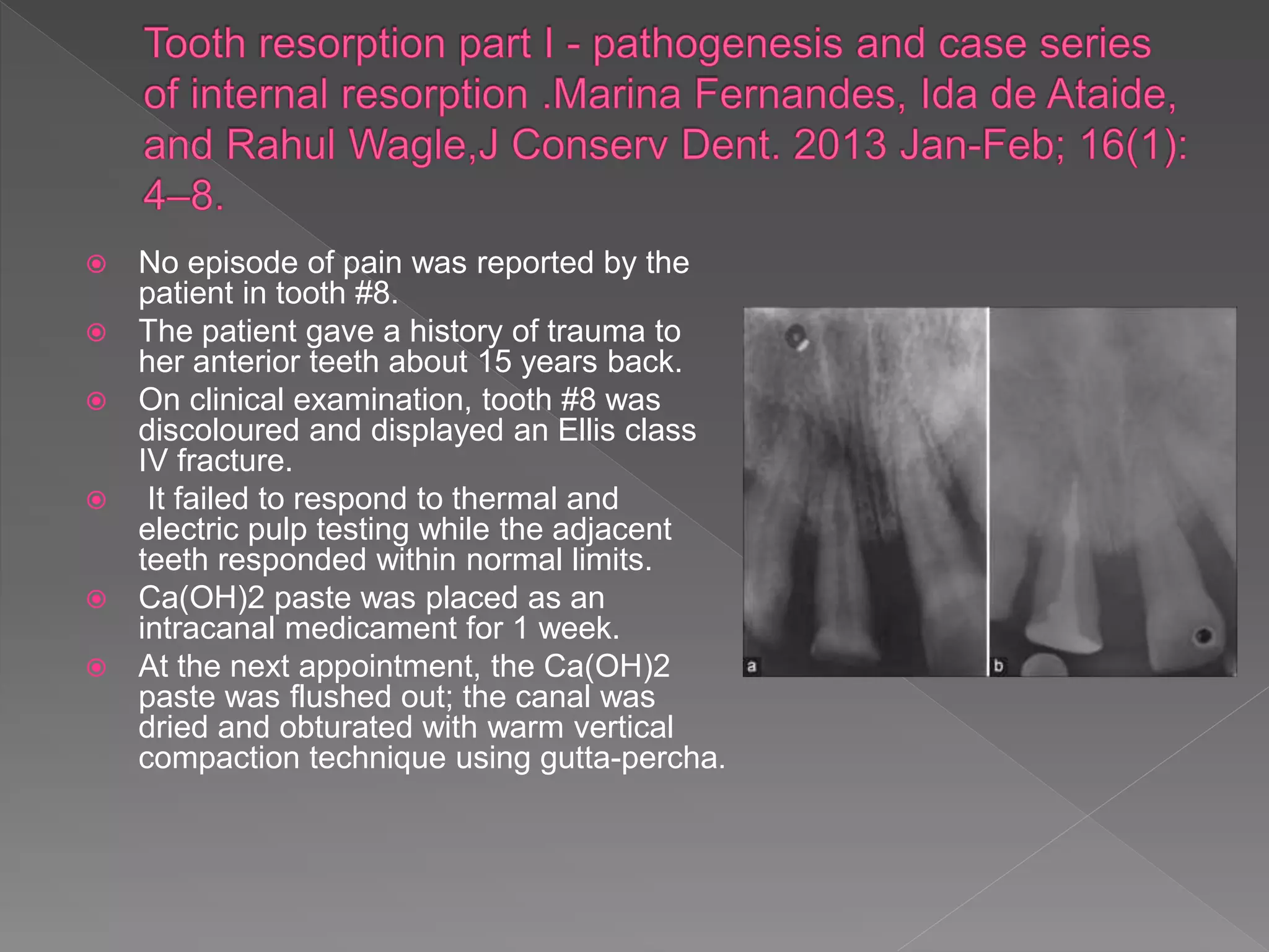  No episode of pain was reported by the
patient in tooth #8.
 The patient gave a history of trauma to
her anterior teeth about 15 years back.
 On clinical examination, tooth #8 was
discoloured and displayed an Ellis class
IV fracture.
 It failed to respond to thermal and
electric pulp testing while the adjacent
teeth responded within normal limits.
 Ca(OH)2 paste was placed as an
intracanal medicament for 1 week.
 At the next appointment, the Ca(OH)2
paste was flushed out; the canal was
dried and obturated with warm vertical
compaction technique using gutta-percha.
 