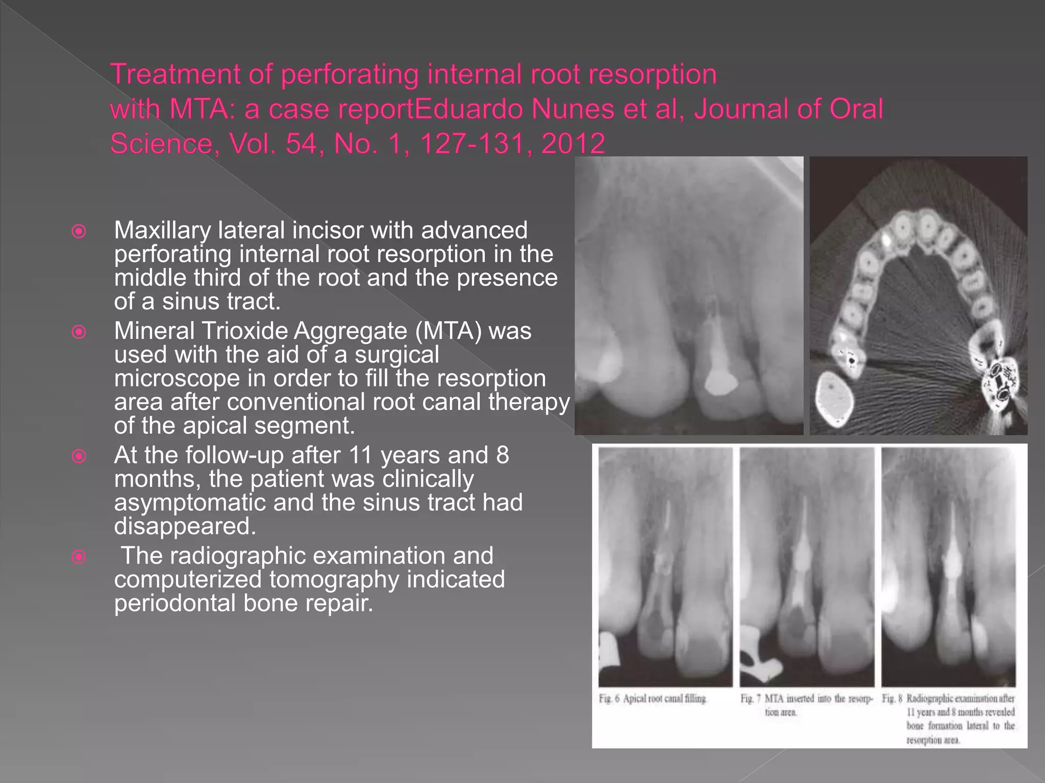  Maxillary lateral incisor with advanced
perforating internal root resorption in the
middle third of the root and the presence
of a sinus tract.
 Mineral Trioxide Aggregate (MTA) was
used with the aid of a surgical
microscope in order to fill the resorption
area after conventional root canal therapy
of the apical segment.
 At the follow-up after 11 years and 8
months, the patient was clinically
asymptomatic and the sinus tract had
disappeared.
 The radiographic examination and
computerized tomography indicated
periodontal bone repair.
 