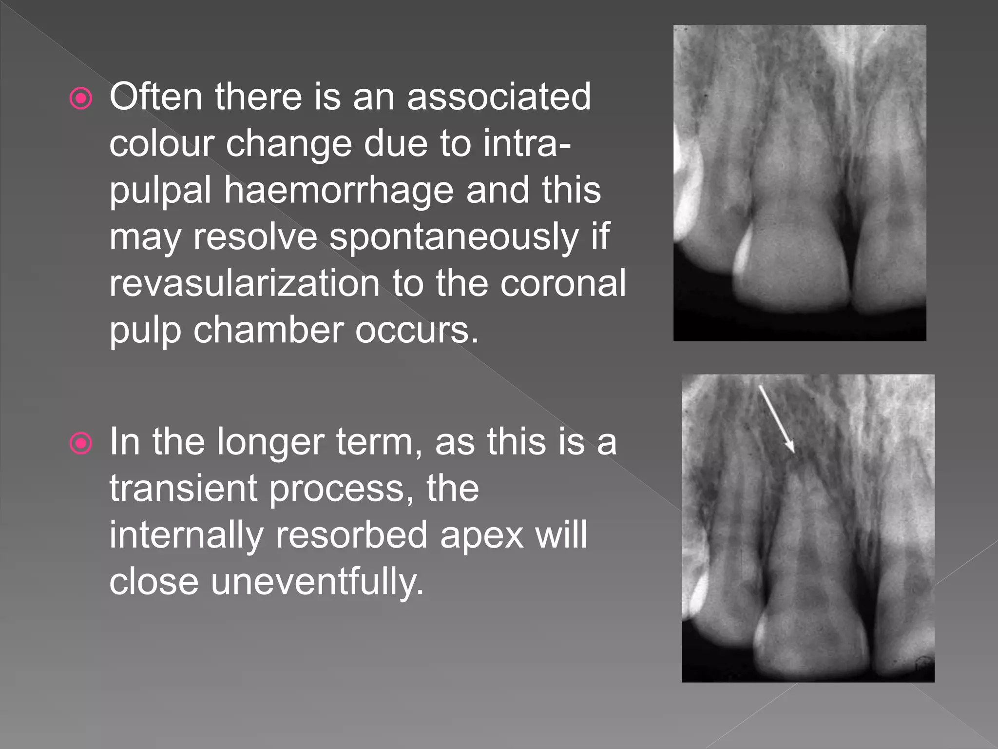  Often there is an associated
colour change due to intra-
pulpal haemorrhage and this
may resolve spontaneously if
revasularization to the coronal
pulp chamber occurs.
 In the longer term, as this is a
transient process, the
internally resorbed apex will
close uneventfully.
 