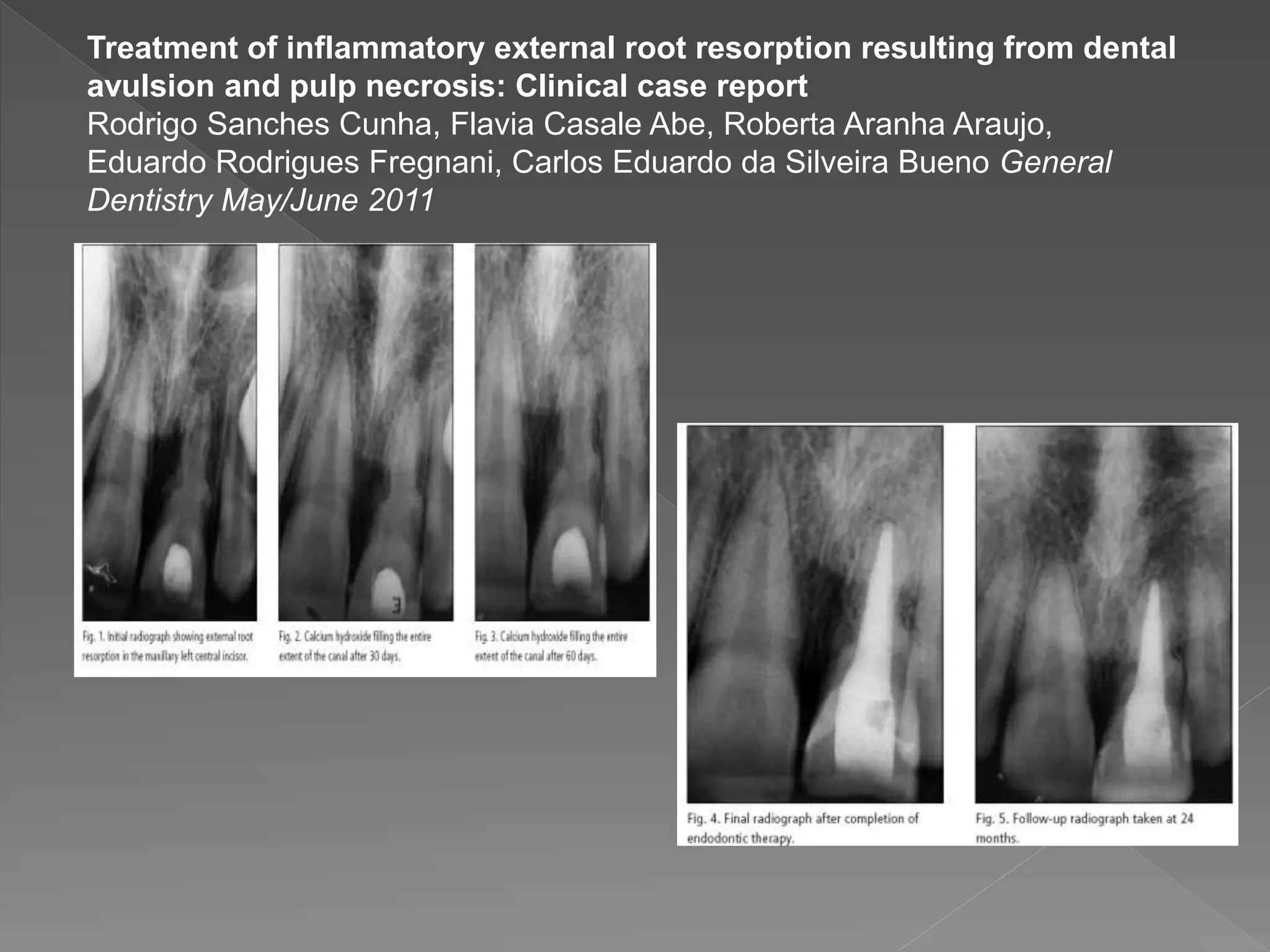 Treatment of inflammatory external root resorption resulting from dental
avulsion and pulp necrosis: Clinical case report
Rodrigo Sanches Cunha, Flavia Casale Abe, Roberta Aranha Araujo,
Eduardo Rodrigues Fregnani, Carlos Eduardo da Silveira Bueno General
Dentistry May/June 2011
 