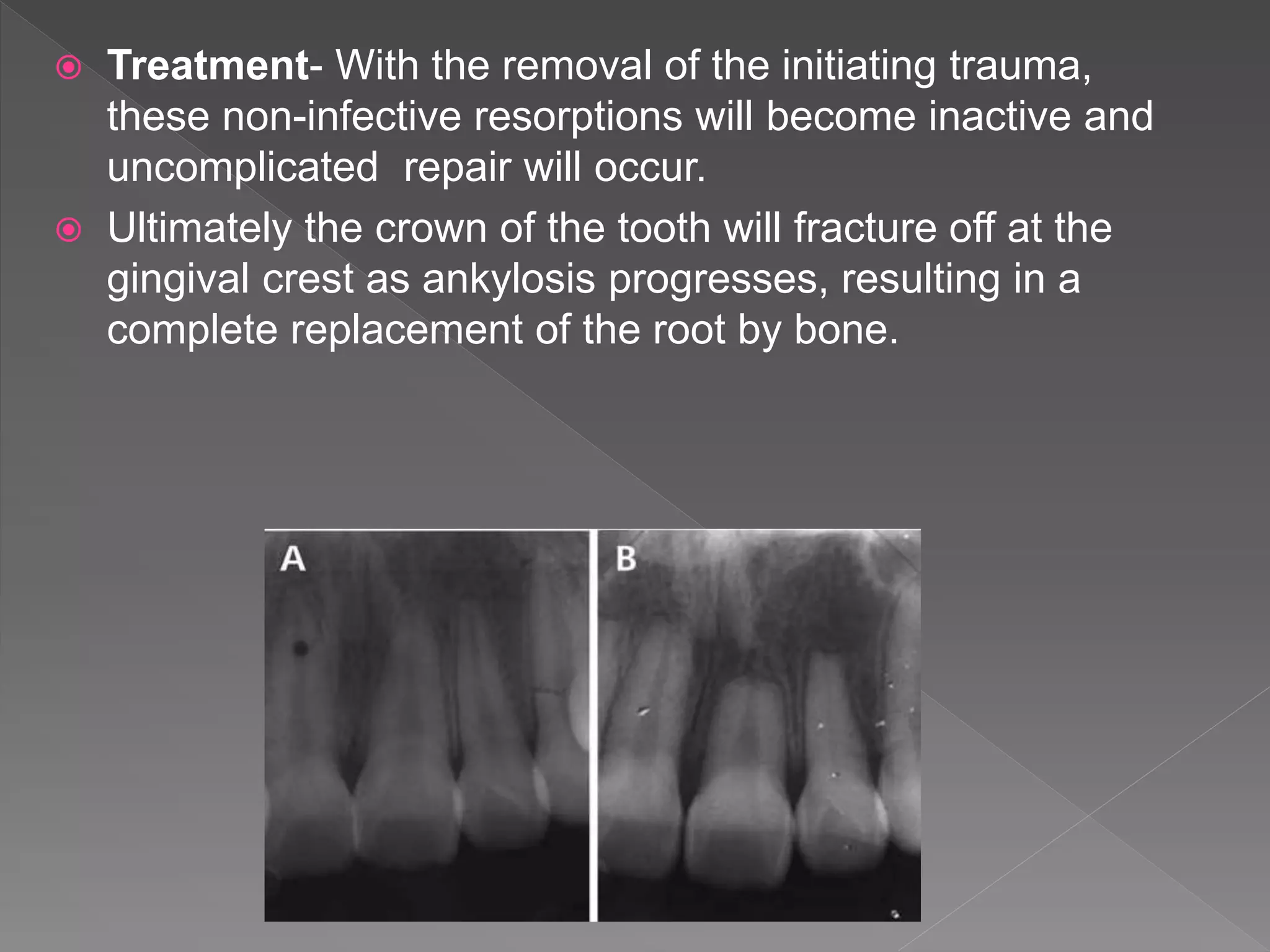  Treatment- With the removal of the initiating trauma,
these non-infective resorptions will become inactive and
uncomplicated repair will occur.
 Ultimately the crown of the tooth will fracture off at the
gingival crest as ankylosis progresses, resulting in a
complete replacement of the root by bone.
 