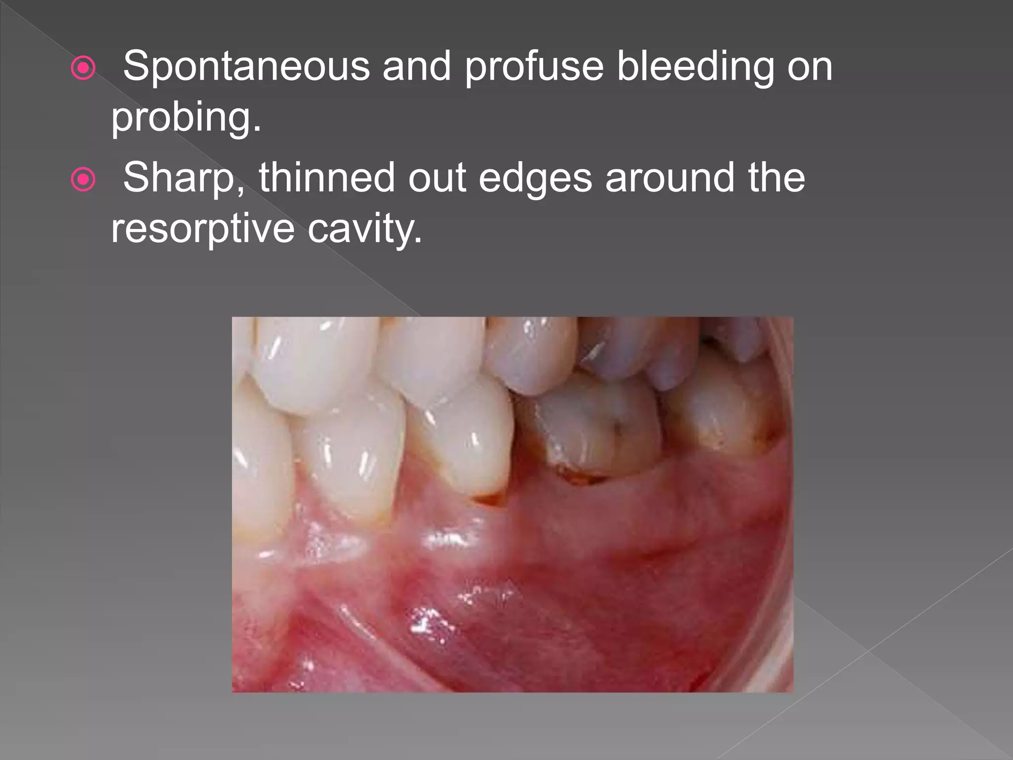  Spontaneous and profuse bleeding on
probing.
 Sharp, thinned out edges around the
resorptive cavity.
 
