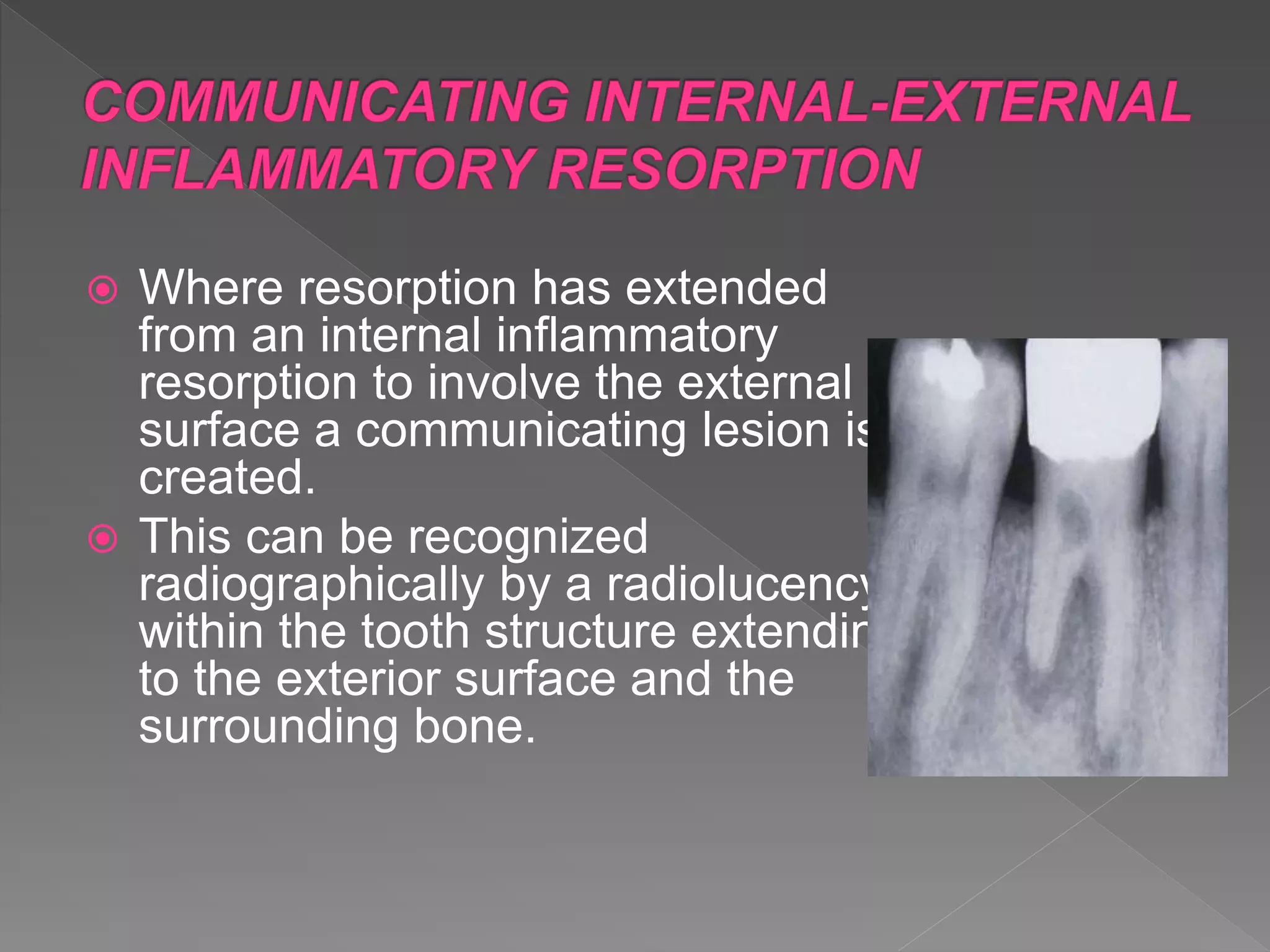  Where resorption has extended
from an internal inflammatory
resorption to involve the external
surface a communicating lesion is
created.
 This can be recognized
radiographically by a radiolucency
within the tooth structure extending
to the exterior surface and the
surrounding bone.
 