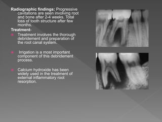Radiographic findings: Progressive
cavitations are seen involving root
and bone after 2-4 weeks. Total
loss of tooth structure after few
months.
Treatment-
 Treatment involves the thorough
debridement and preparation of
the root canal system.
 Irrigation is a most important
component of this debridement
process.
 Calcium hydroxide has been
widely used in the treatment of
external inflammatory root
resorption.
 