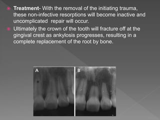  Treatment- With the removal of the initiating trauma,
these non-infective resorptions will become inactive and
uncomplicated repair will occur.
 Ultimately the crown of the tooth will fracture off at the
gingival crest as ankylosis progresses, resulting in a
complete replacement of the root by bone.
 