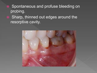 Spontaneous and profuse bleeding on
probing.
 Sharp, thinned out edges around the
resorptive cavity.
 