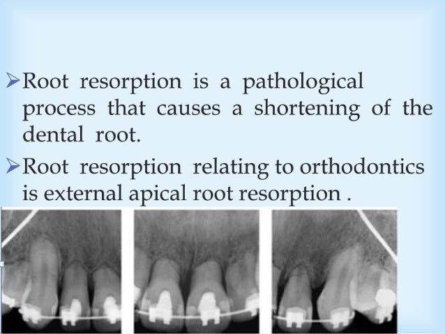root resorption
