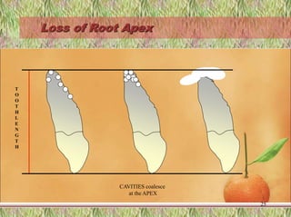 Loss of Root Apex
25
T
O
O
T
H
L
E
N
G
T
H
CAVITIES coalesce
at the APEX
 
