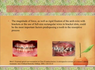 • The magnitude of force, as well as rigid fixation of the arch-wire with
brackets or the use of full-size rectangular wires in bracket slots, could
be the most important factors predisposing a tooth to the resorptive
process
30
Brin I. External apical root resorption in Class II malocclusion: A retrospective review of 1-versus 2-phase
treatment. Am J Orthod Dentofac Orthop. 2003; 124:151-6
 