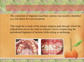 • The correction of impacted maxillary canines was recently identified
as a risk factor for root resorption.
• This might be a result of the ectopic eruption path through which the
orthodontist moves the teeth or intrusive forces compressing the
periodontal ligament of incisors while acting as anchorage.
68
 