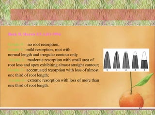 82
Beck B, Harris EF.AJO 1994
Grade 0 - no root resorption;
Grade 1 - mild resorption, root with
normal length and irregular contour only
Grade 2 - moderate resorption with small area of
root loss and apex exhibiting almost straight contour;
Grade 3 - accentuated resorption with loss of almost
one third of root length;
Grade 4 - extreme resorption with loss of more than
one third of root length.
 