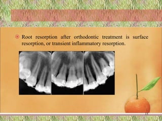  Root resorption after orthodontic treatment is surface
resorption, or transient inflammatory resorption.
15
 