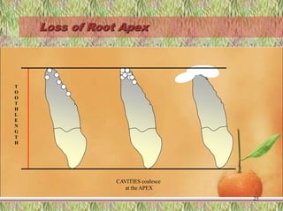 Loss of Root Apex
25
T
O
O
T
H
L
E
N
G
T
H
CAVITIES coalesce
at the APEX
 