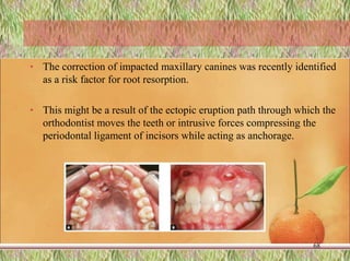 • The correction of impacted maxillary canines was recently identified
as a risk factor for root resorption.
• This might be a result of the ectopic eruption path through which the
orthodontist moves the teeth or intrusive forces compressing the
periodontal ligament of incisors while acting as anchorage.
68
 