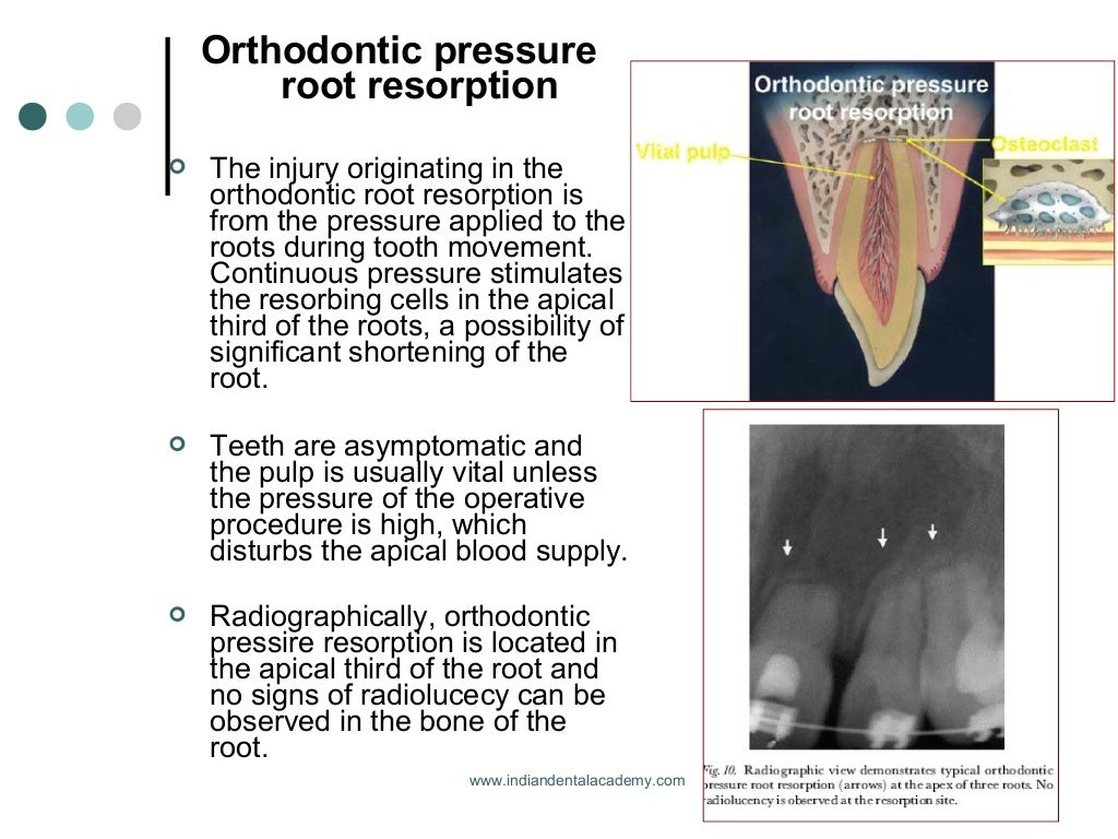 Root resorption in orthodontics /certified fixed orthodontic courses…