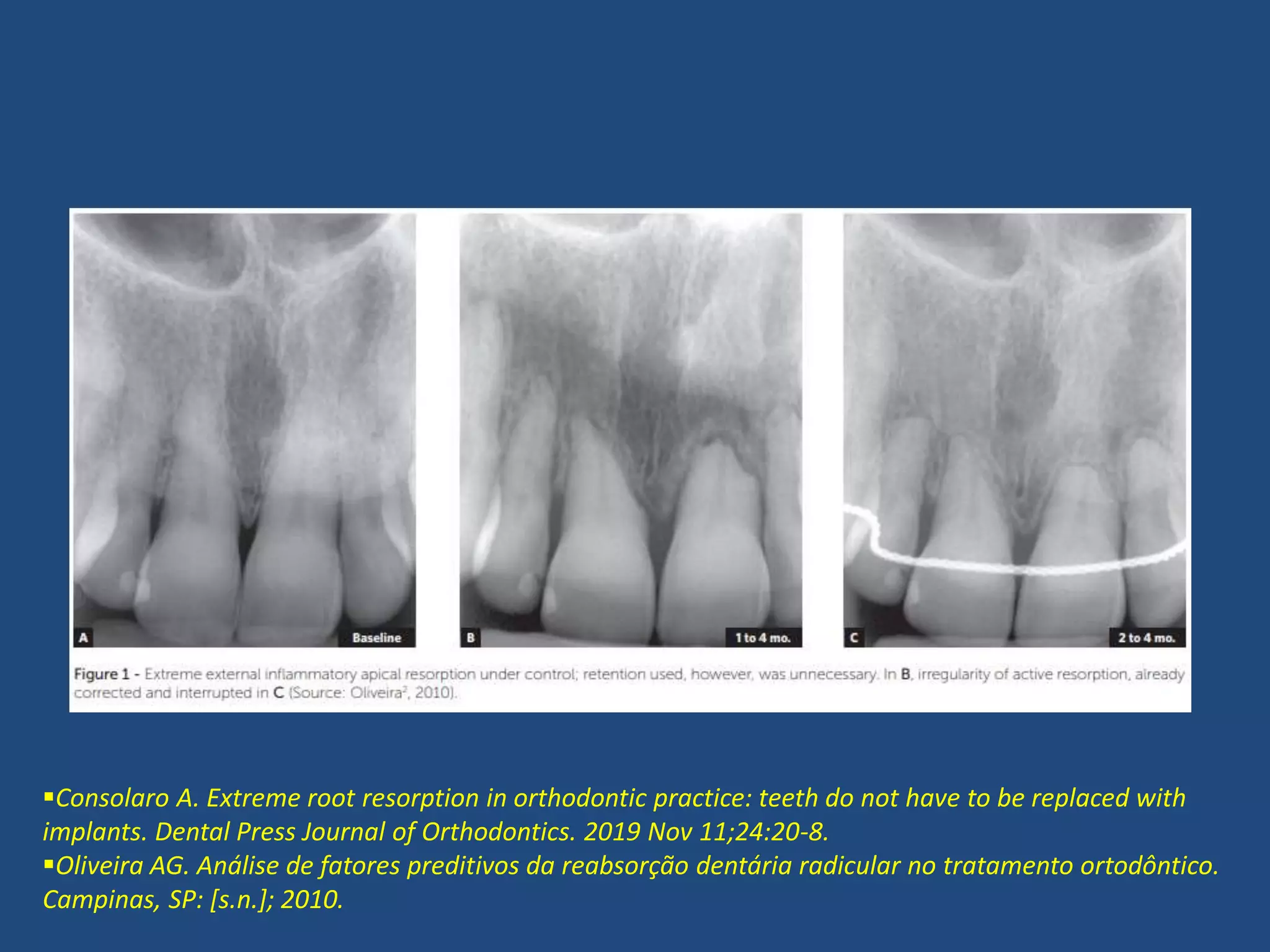 Consolaro A. Extreme root resorption in orthodontic practice: teeth do not have to be replaced with
implants. Dental Press Journal of Orthodontics. 2019 Nov 11;24:20-8.
Oliveira AG. Análise de fatores preditivos da reabsorção dentária radicular no tratamento ortodôntico.
Campinas, SP: [s.n.]; 2010.
 
