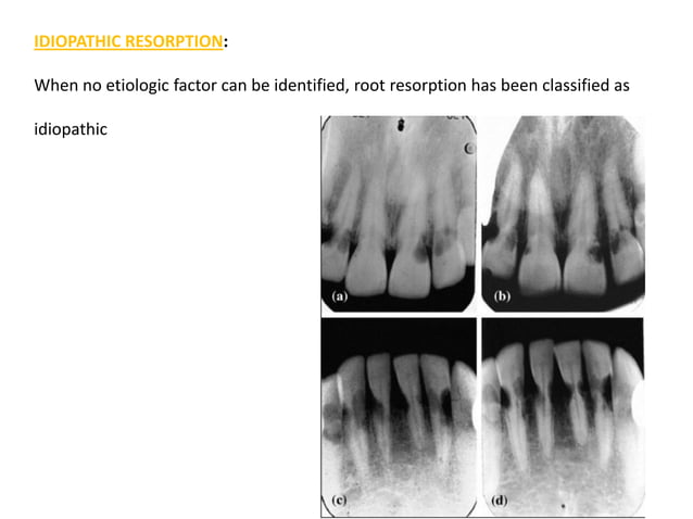 Root Resorption | PPT | Free Download