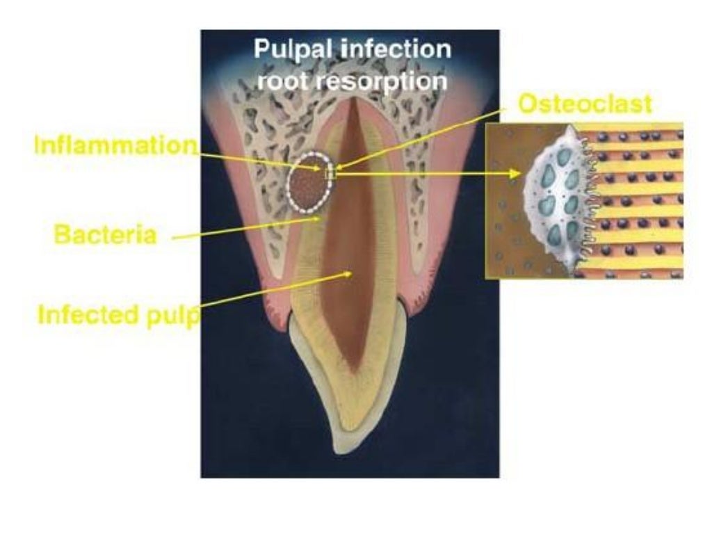 Root Resorption