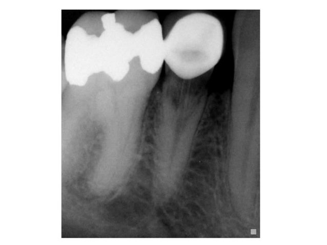 root resorption