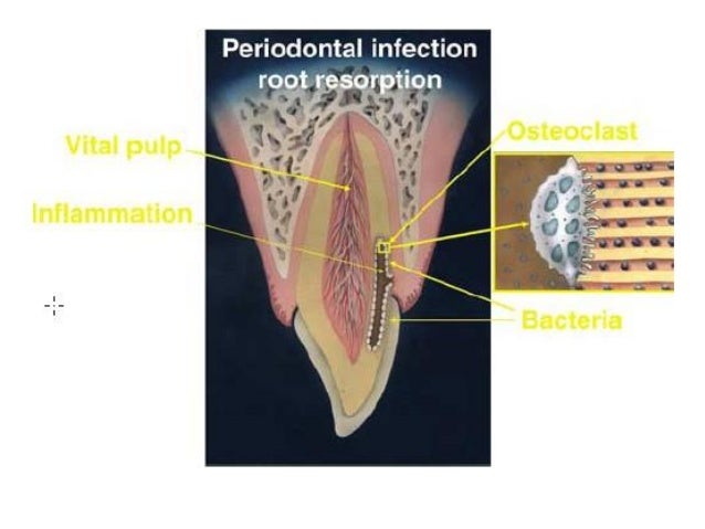 root resorption