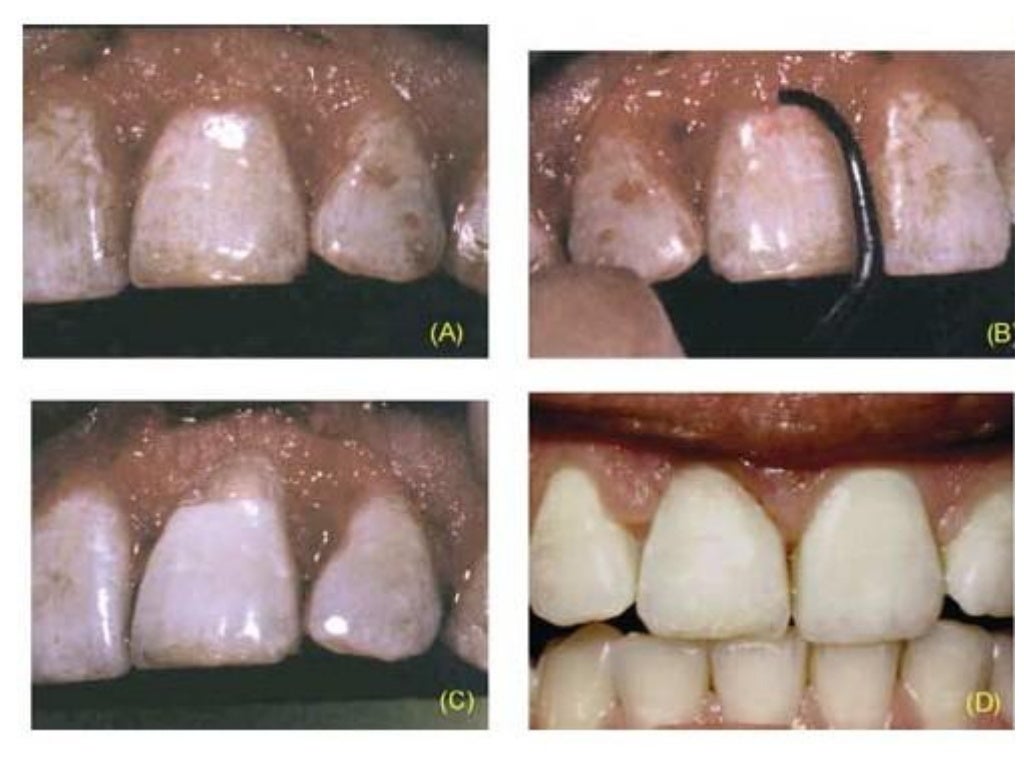 Root Resorption