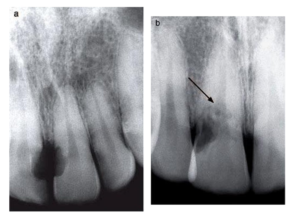 Root Resorption